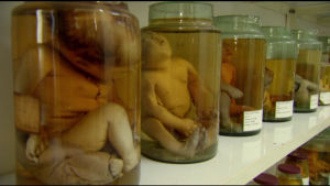Les bocaux avec les fœtus aux malformations monstrueuses sont censés démontrer la nocivité des dioxines. Mais aucune étude scientifique solide n'a permis d'aller dans ce sens, affirme Denis Bard, épidémiologiste.